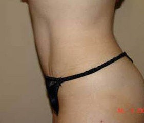 Tummy tuck after 172704