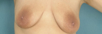 Areola Reduction and Breast Augmentation before 100248