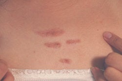 Keloid Scar Removal Los Angeles after 145657