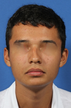nasal airway surgery with cosmetic improvement before 478799