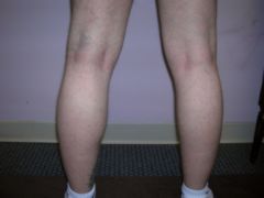 Calf Implants before 258997