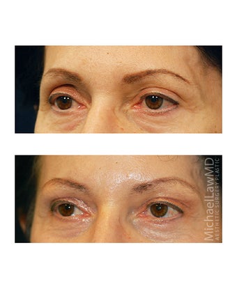 Facial Rejuvenation - Brow Lift before 395967