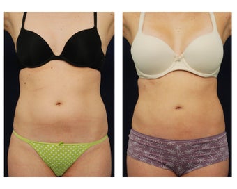 Liposuction before 396991