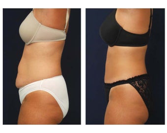Tummy Tuck or Abdominoplasty before 283168