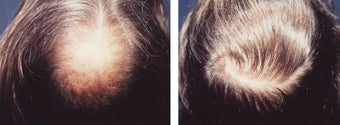 hair transplant before 369172