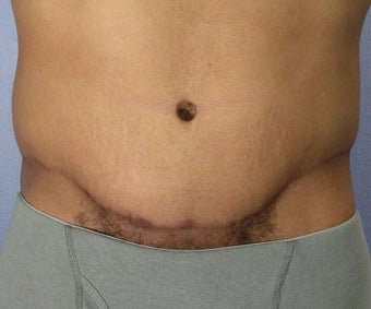Male Body Contouring after 280189