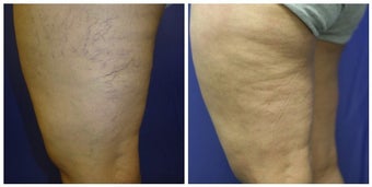 spider vein sclerotherapy with asclera before 392260