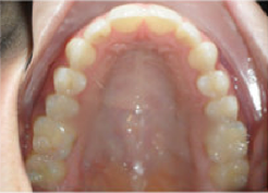 Invisalign 24 Months Severe Over Jet and Tongue Thrust after 349090
