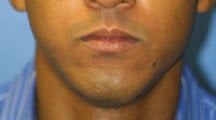 Lip Surgery, Lip Reduction after 459004