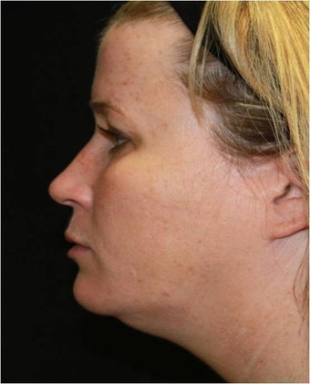 Ultherapy 445623