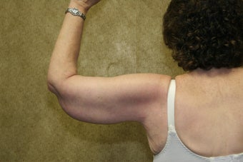 Brachioplasty or arm tuck in los angeles 583676