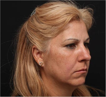 Restylane & Juvederm 444312