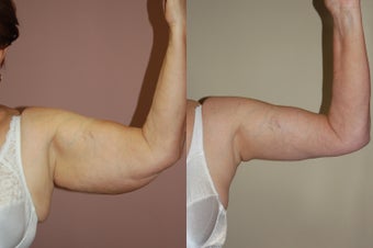 Arm Lift (Brachioplasty) before 350266