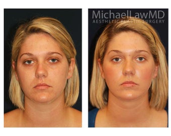 Chin Liposuction before 395411