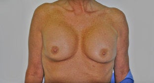 Implant Correction before 494513