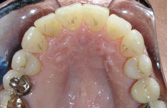 Invisalign: dramatic rotation of front teeth after 275754