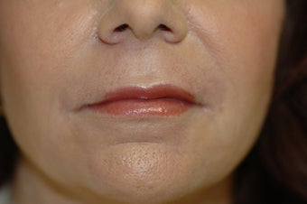 Laser skin resurfacing, eyelid surgery, lip augmentation 434871
