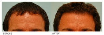 Botox before 138525