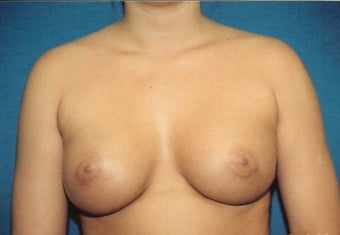 Breast Augmentation after 266922
