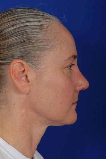 Revision Rhinoplasty after 274927