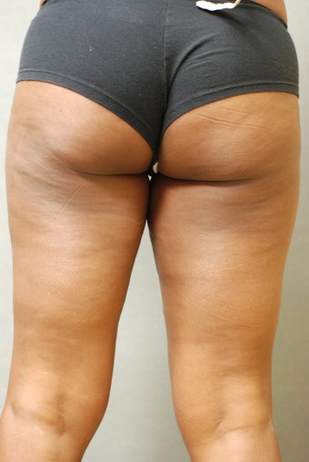 SmartLipo™ Trimming the rubbing Thighs before 451431