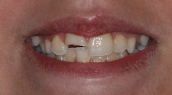 Cosmetic Composite Resin for Broken Front Tooth in Teenager before 463699