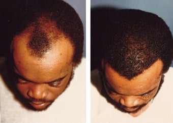 hair transplant before 369167