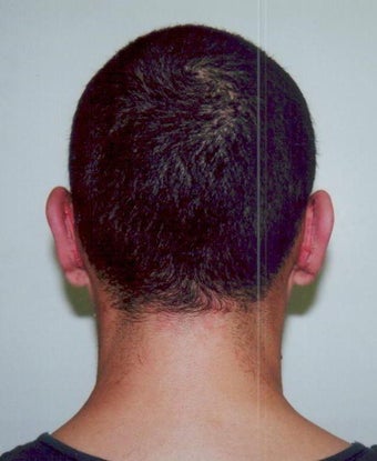 Otoplasty - Bilateral protruding ears after 393546