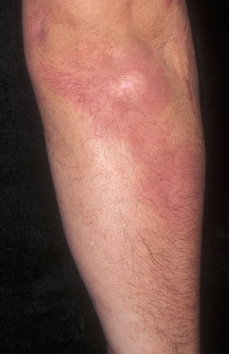 Psoriasis Treatment after 359385