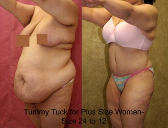 tummy tuck after 304693