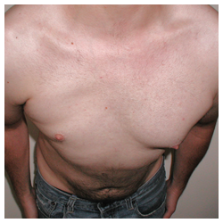 Chest implant for patient with Poland’s syndrome before 334390