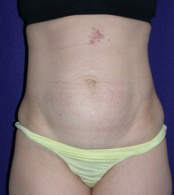 Tummy Tuck (abdominoplasty) before 208463