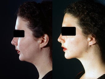 Chin and Neck Liposuction before 449928