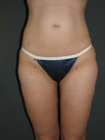Smart Lipo of Hips, Saddle Bags, and Inner Thighs after 325110