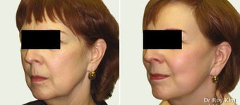 Facelift before 359612