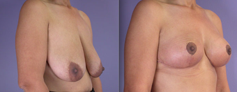 Nipple Surgery before 293280