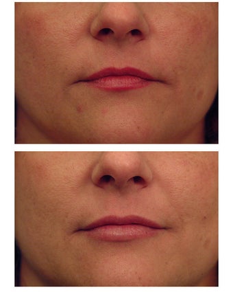 Injectable Filler before 149357