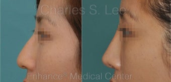 Nose before 431418