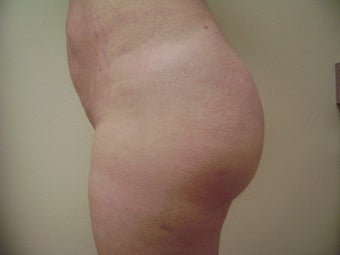 Brazilian Butt Lifts after 138165