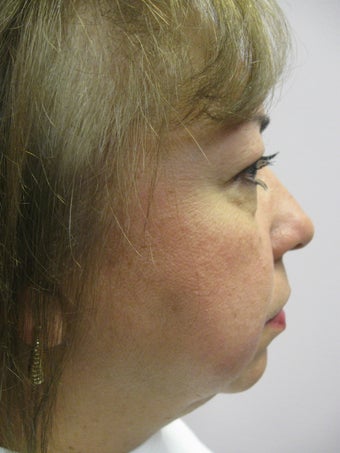 Chin Implant before 340063