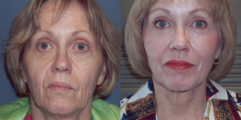 CO2 Laser skin resurfacing before 78396