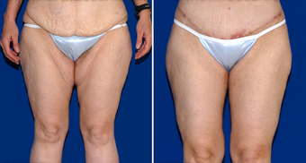 Thigh Lift before 495818