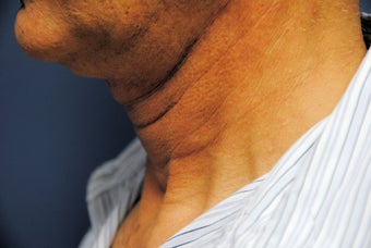 Ultherapy - immediately before and after before 623869