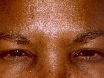 Botox after 469311