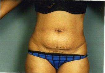 Mini Tummy Tuck before 215155