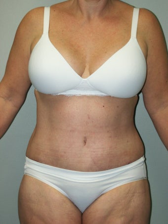 Belt Lipectomy after 379797