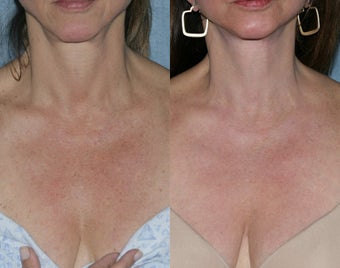 Fraxel Repair with Vbeam Perfecta and Alexandrite Lasers before 105208