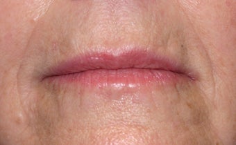 Restylane injection to nasolabial folds after 240182