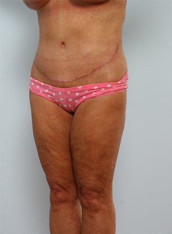 Body Lift after 260130