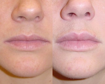 Restylane before 96277